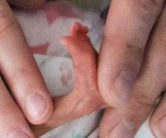 Ella, IWK Patient